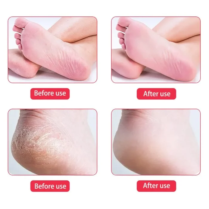 Double-Side Foot Dead Skin Remover - Image 4